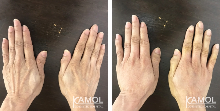 Hand Rejuvenation Treatment 6 lg 6494959f5822a image