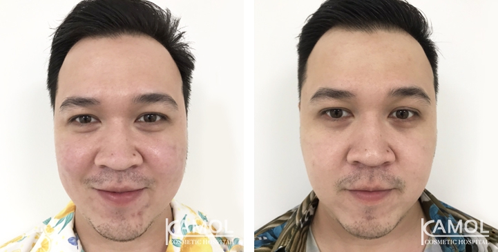 Melasma 2 lg 6494959f6dd36 image