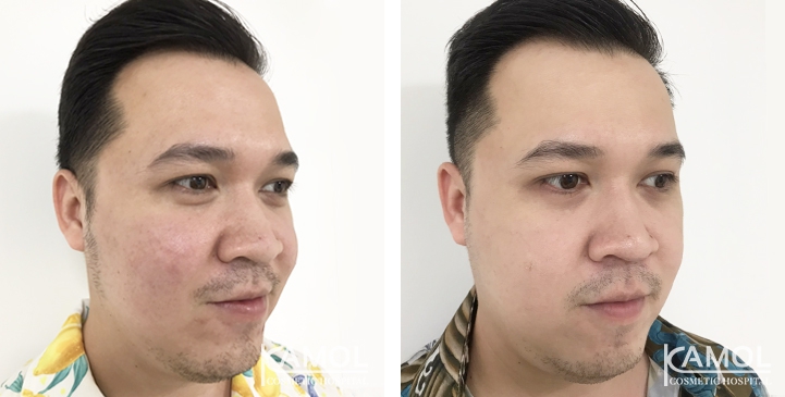 Melasma 4 lg 6494959f6fc03 image