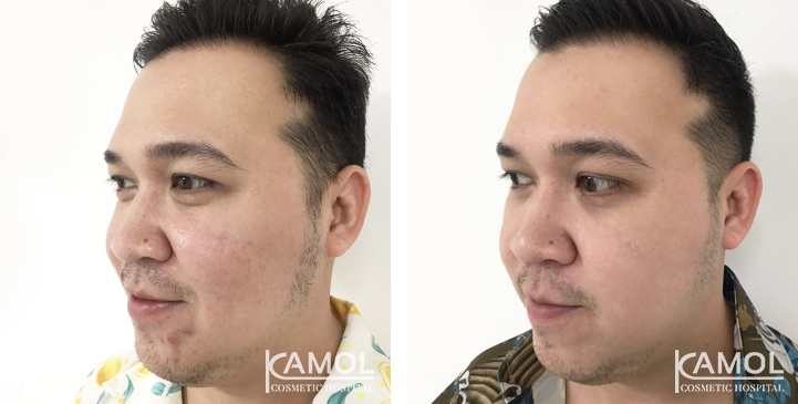 Melasma 3 lg 6494959f71a62 image