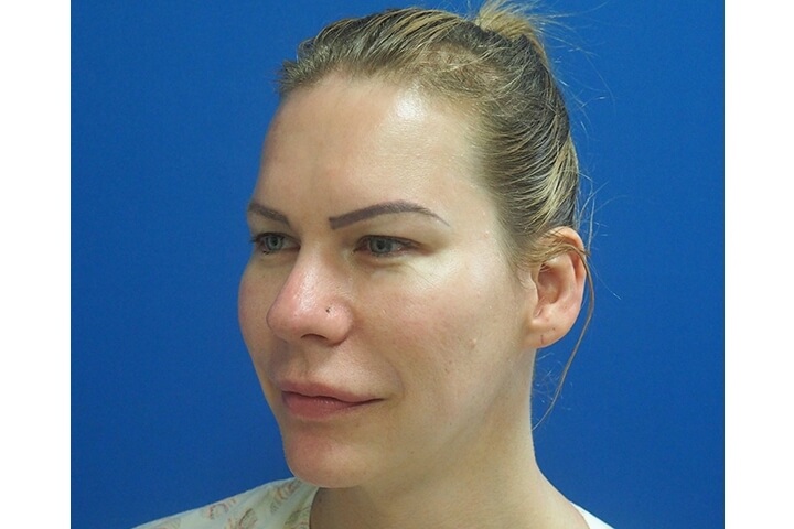 Abaissement de la Ligne des Cheveux / Avancement du Cuir Chevelu 20 lg 649f88954126e image