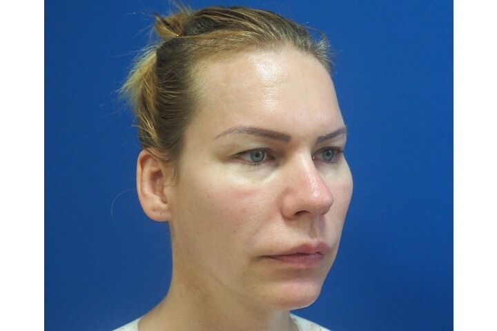 Abaissement de la Ligne des Cheveux / Avancement du Cuir Chevelu 13 lg 649f889542d8b image