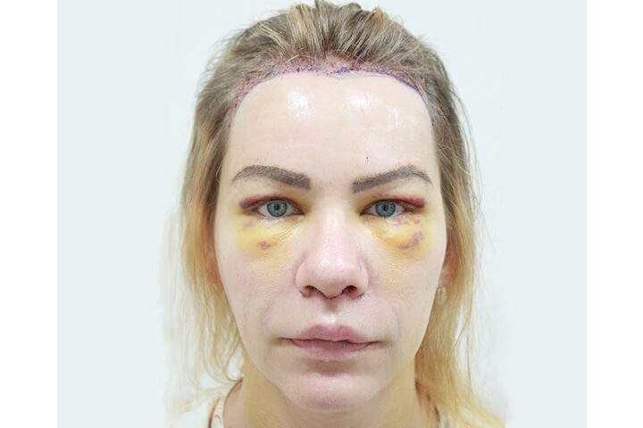 Abaissement de la Ligne des Cheveux / Avancement du Cuir Chevelu 17 lg 649f8895444c3 image