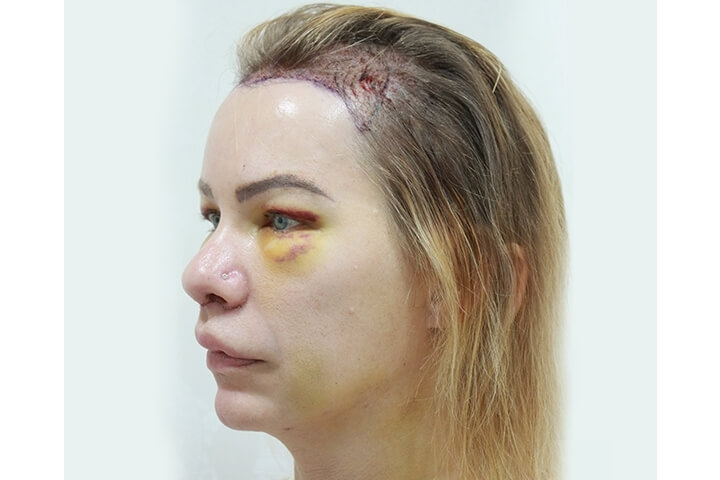 Abaissement de la Ligne des Cheveux / Avancement du Cuir Chevelu 14 lg 649f889545aab image