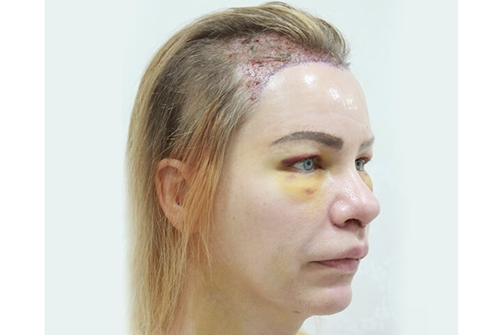 Abaissement de la Ligne des Cheveux / Avancement du Cuir Chevelu 21 lg 649f889547488 image