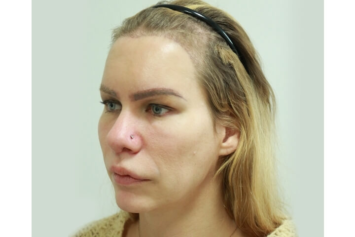Abaissement de la Ligne des Cheveux / Avancement du Cuir Chevelu 9 lg 649f88954ab96 image