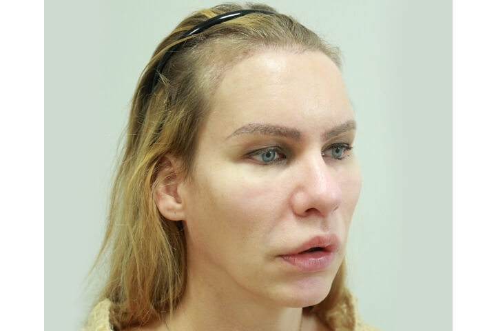 Abaissement de la Ligne des Cheveux / Avancement du Cuir Chevelu 10 lg 649f88954c3e8 image