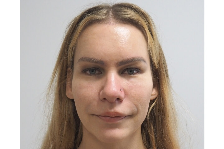 Abaissement de la Ligne des Cheveux / Avancement du Cuir Chevelu 11 lg 649f88954db37 image