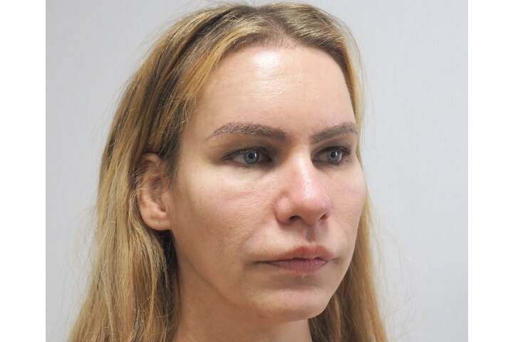 Abaissement de la Ligne des Cheveux / Avancement du Cuir Chevelu 15 lg 649f889550b9c image