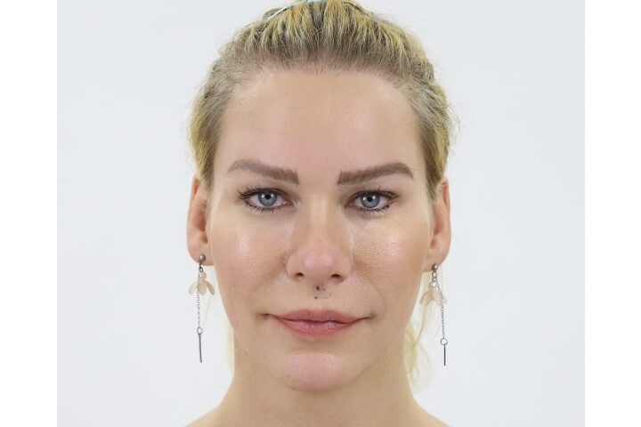 Abaissement de la Ligne des Cheveux / Avancement du Cuir Chevelu 19 lg 649f8895521db image