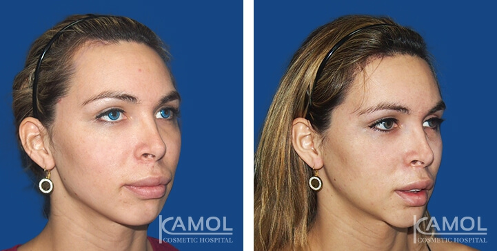 Augmentation du Menton / Implant du Menton 10 lg 649f8895ba82b image