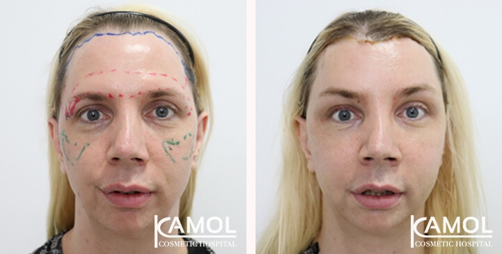 Réduction du Menton / Génioplastie 13 lg 649f8895d0376 image