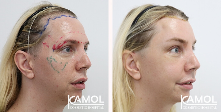 Réduction du Menton / Génioplastie 15 lg 649f8895d4c04 image