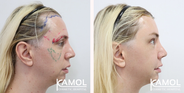 Réduction du Menton / Génioplastie 16 lg 649f8895d6fa3 image
