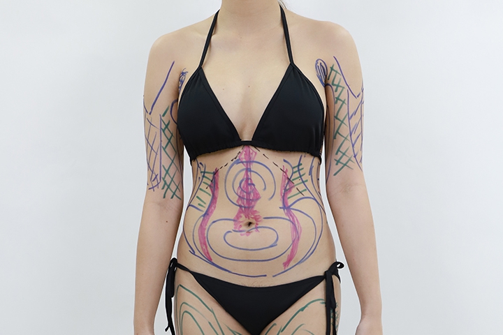 Liposuccion 11 lg 649f88968683f image