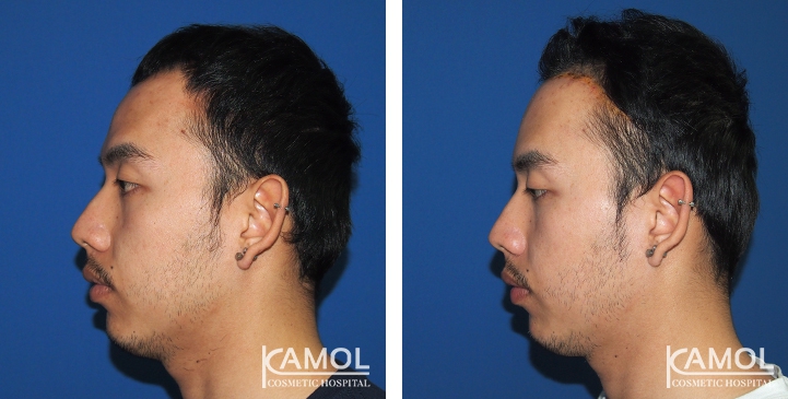 Abaissement de la Ligne des Cheveux / Avancement du Cuir Chevelu 5 lg 649f8936394b7 image