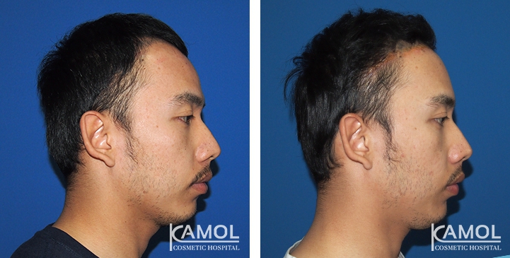 Abaissement de la Ligne des Cheveux / Avancement du Cuir Chevelu 7 lg 649f89363d992 image