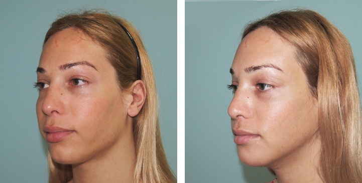 Réduction du Menton / Génioplastie 11 lg 649f893ec59fa image