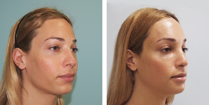 Réduction du Menton / Génioplastie 9 lg 649f893ec9b5e image