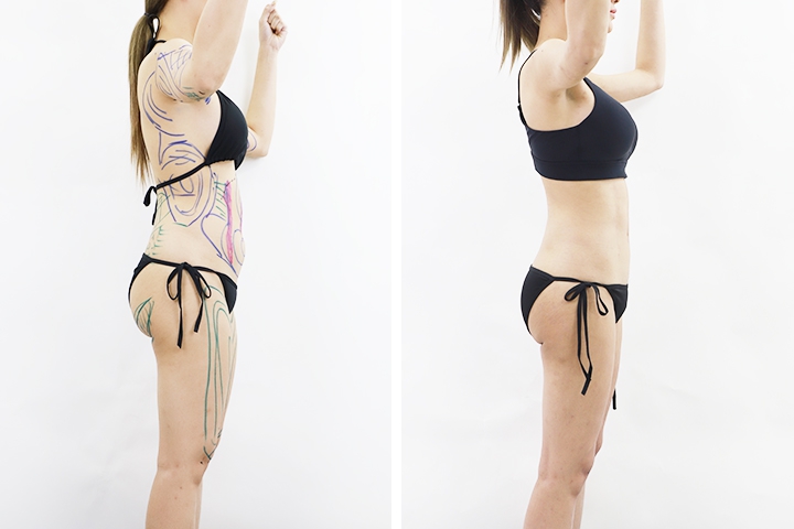 Liposuccion 3 lg 649f894b527d7 image