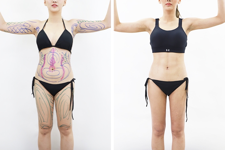 Liposuccion 5 lg 649f894b55c61 image