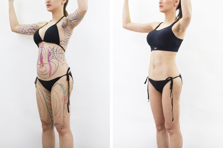 Liposuccion 6 lg 649f894b57875 image