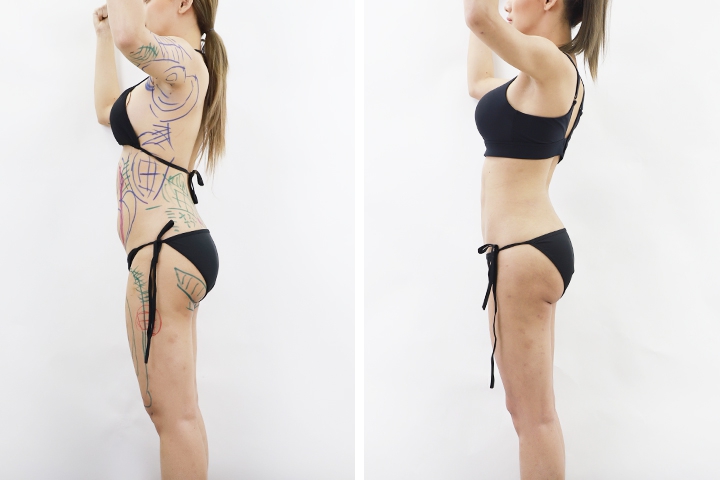 Liposuccion 7 lg 649f894b5932a image
