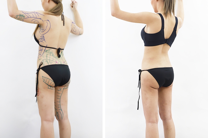 Liposuccion 8 lg 649f894b5af78 image