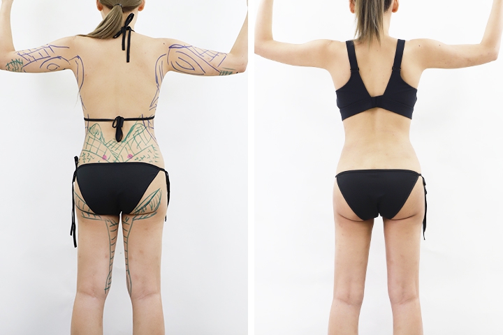 Liposuccion 9 lg 649f894b5c73e image