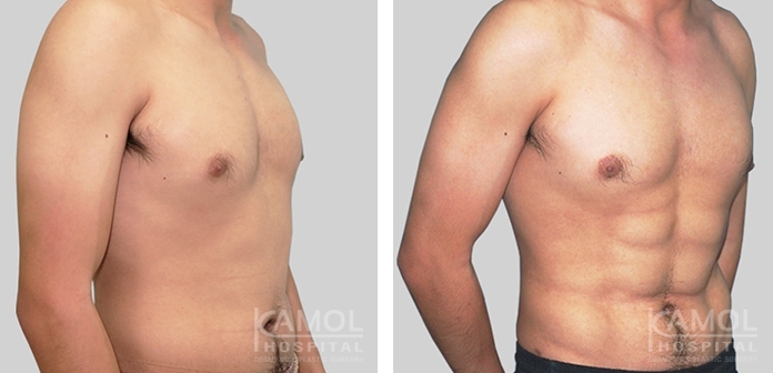 Chirurgie Six Pack 7 lg 649f89510f711 image