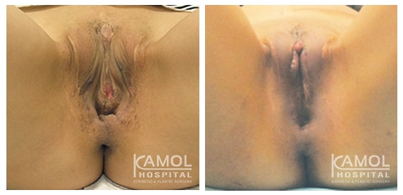إعادة جراحة تجميل المهبل 4 lg 64d756c4d699e image