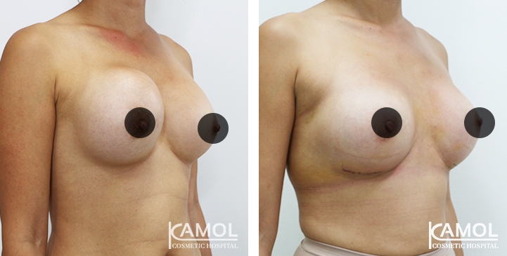 Correção de mama para mulheres trans 3 lg 64dc422868d79 image
