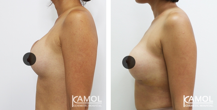 Correção de mama para mulheres trans 6 lg 64dc4228a752a image