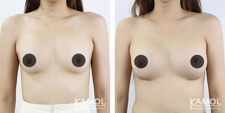 Correção de mama para mulheres trans 14 lg 64dc4268c5978 image