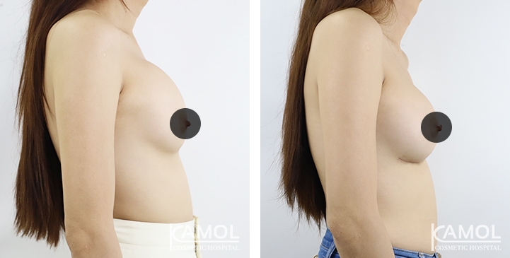 Correção de mama para mulheres trans 18 lg 64dc4268e01f2 image