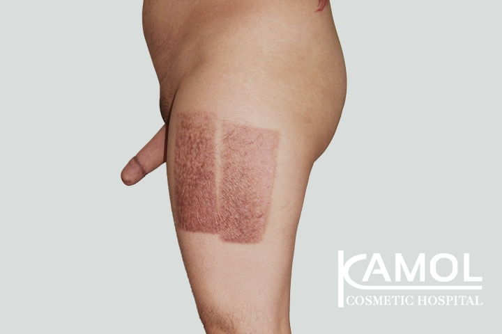 Faloplastia 41 lg 650d98ab01ce0 image
