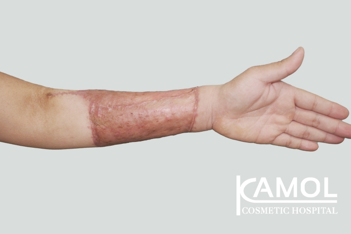 Faloplastia 44 lg 650d98b190cbc image