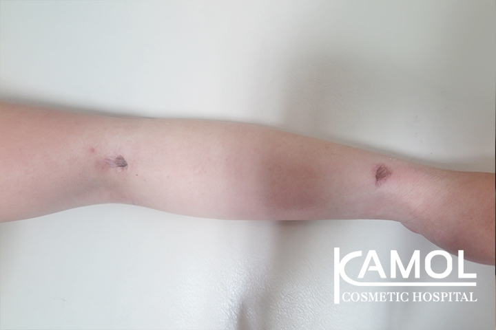 Faloplastia 42 lg 650d98b8e195b image