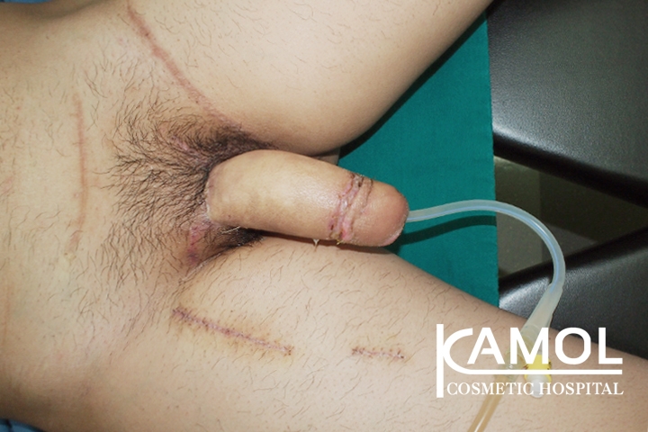 Faloplastia 45 lg 650d98bc57be6 image