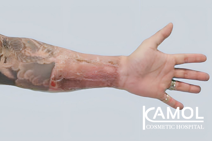 Faloplastia 52 lg 650d992d724d6 image