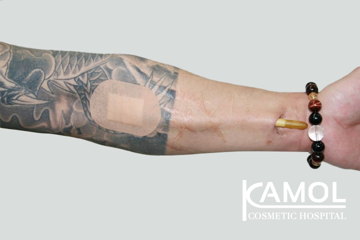 Faloplastia 49 lg 650d993121a8b image