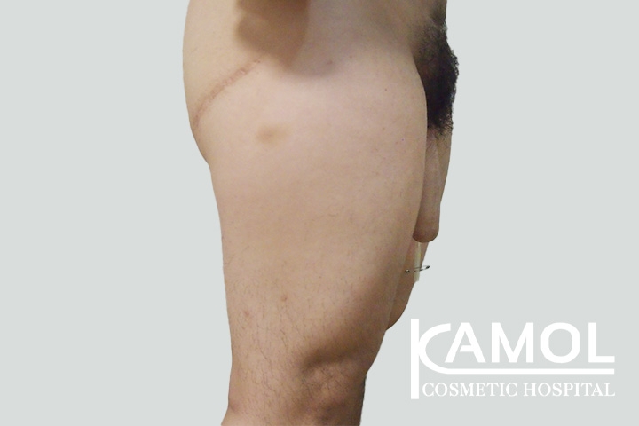 Faloplastia 59 lg 650d998fa8965 image