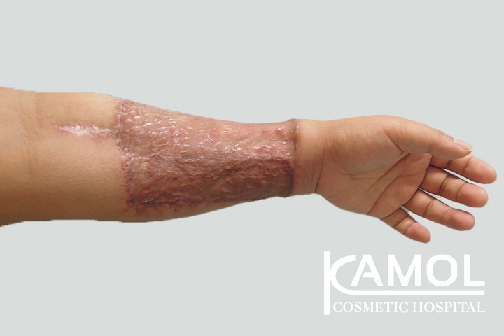 Faloplastia 58 lg 650d999a609de image