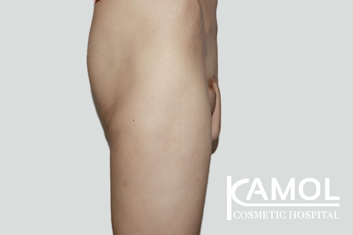 Faloplastia 66 lg 650d99f20ffd1 image
