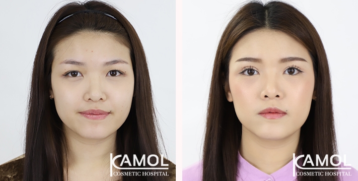 Blepharoplasty / Eyelid Surgery 2 lg 65125fa01b1fe image