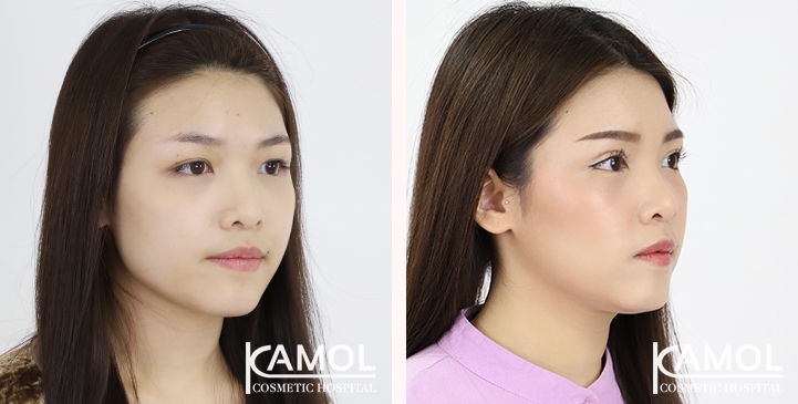 Blepharoplasty / Eyelid Surgery 4 lg 65125fa0406d4 image
