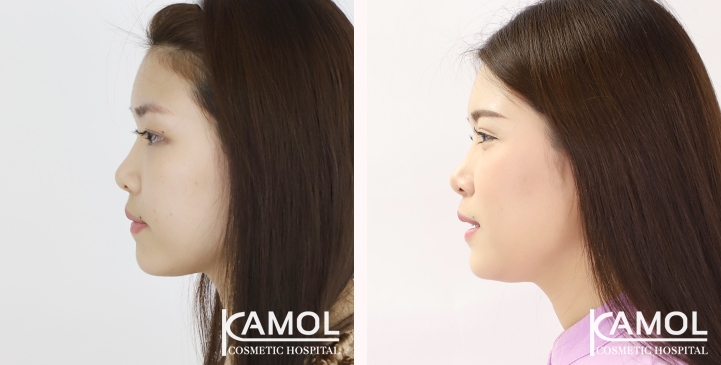 Blepharoplasty / Eyelid Surgery 5 lg 65125fa0656ff image