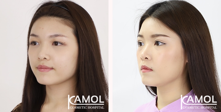 Blepharoplasty / Eyelid Surgery 3 lg 65125fa0a566f image