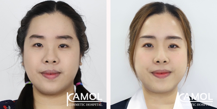 Blepharoplasty / Eyelid Surgery 8 lg 651393079a7e2 image