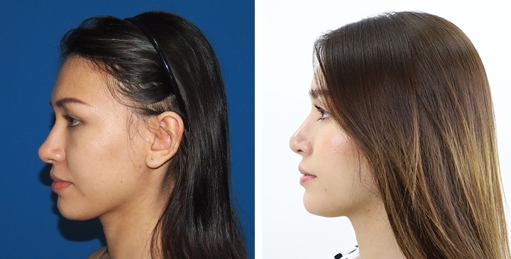 Blepharoplasty / Eyelid Surgery 75 lg 6516cdb9805c7 image